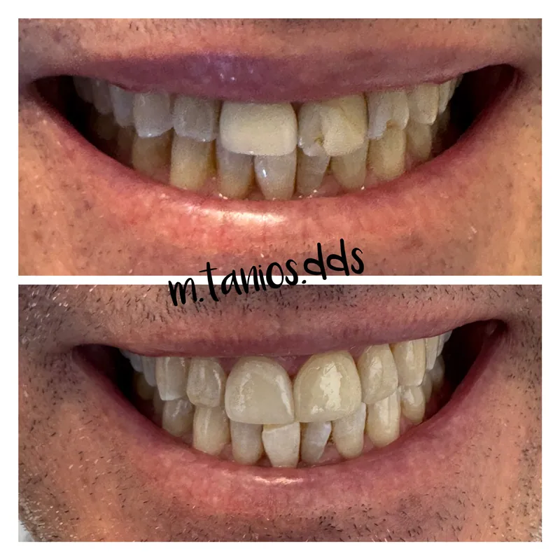 2 photos displaying before and after crowns