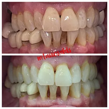2 photos displaying open mouth before and after invisalign