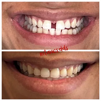 2 photos of open mouth before and after invisalign